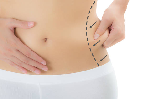 Non-Surgical Liposuction Treatment